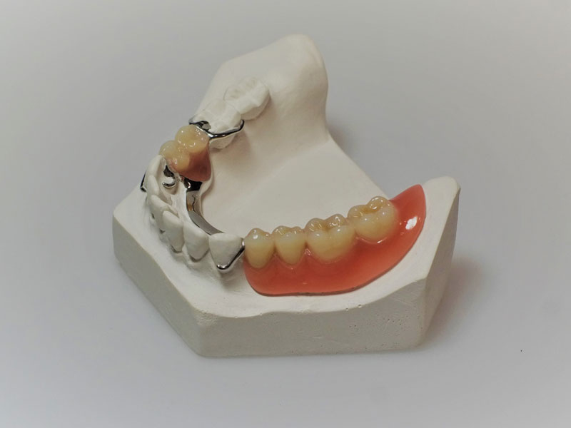 Praxis für Zahnprothetik - Teilprothese auf Modell